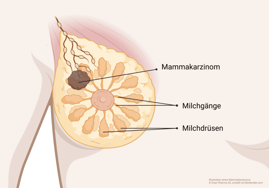Brustkrebs, in der Medizin auch Mammakarzinom genannt, ist eine Tumorerkrankung der Brust.