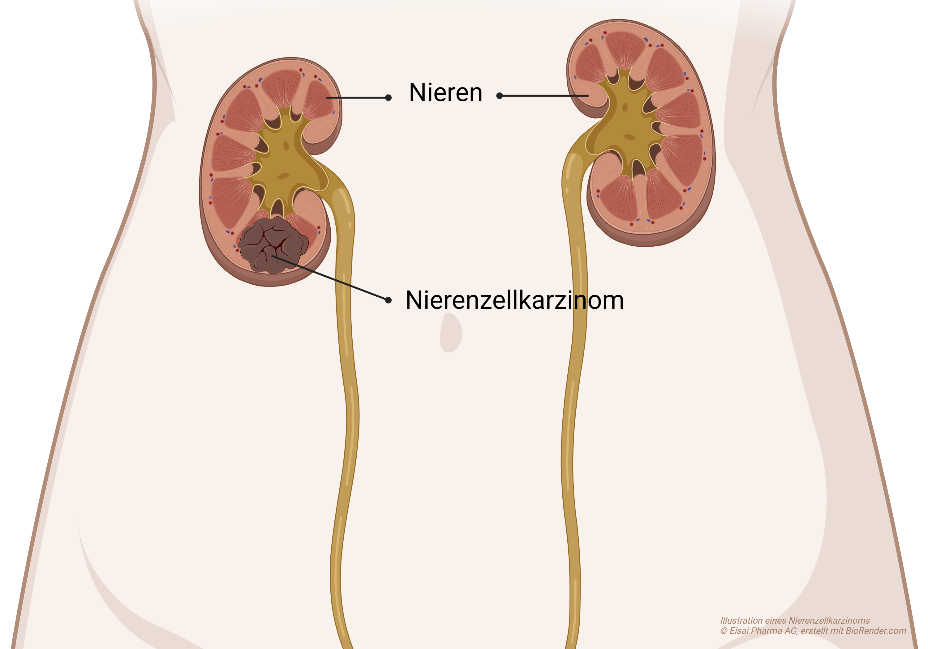 Eisai.ch_Onkologie-Nierenzellkarzinom_2 Nierenkrebs, auch bekannt als Nierenkarzinom, Nierenzellkarzinom oder Adenokarzinom der Niere, ist eine Tumorerkrankung der Niere.