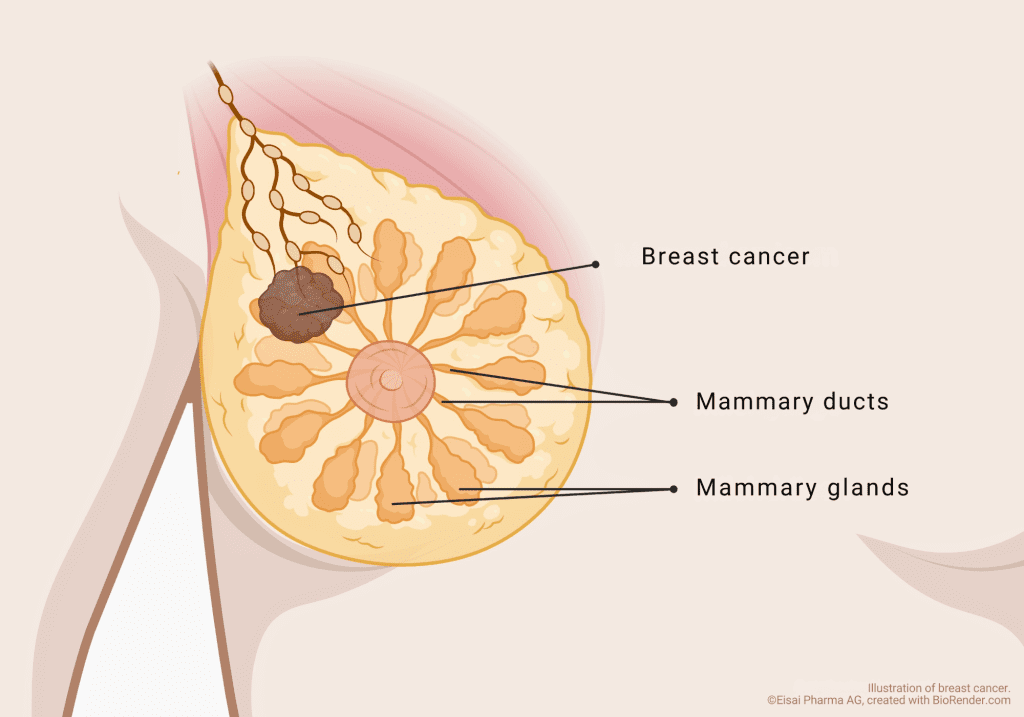 Breast cancer, also known as mammary carcinoma in medicine, is a tumor disease of the breast.
