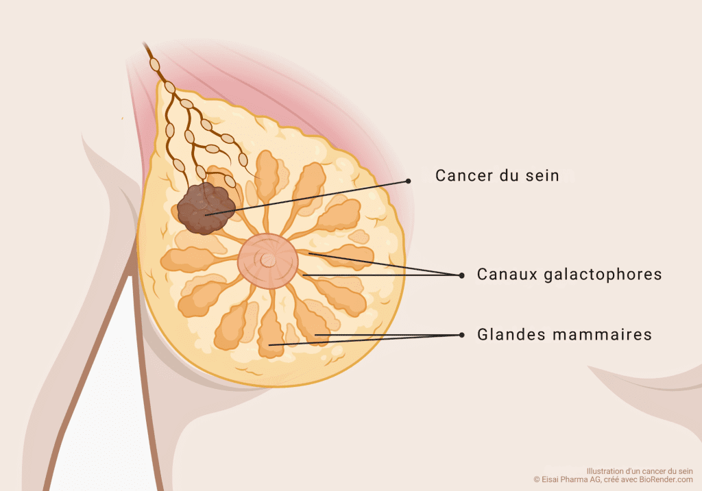 3 – Mammakarzinom_FR